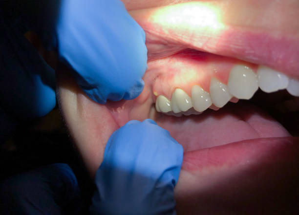 Best Emergency Denture Repair in Citrus City, TX