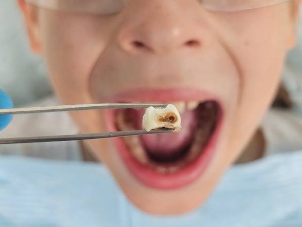 Best Emergency Wisdom Tooth Extraction in Citrus City, TX